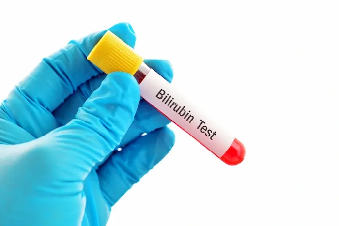 bilirubin test